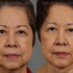 Face lift & Neck lift Before and After Photos in Newburgh, NY, Patient 12641