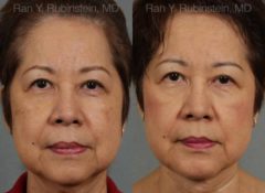 Face lift & Neck lift Before and After Photos in Newburgh, NY, Patient 12641