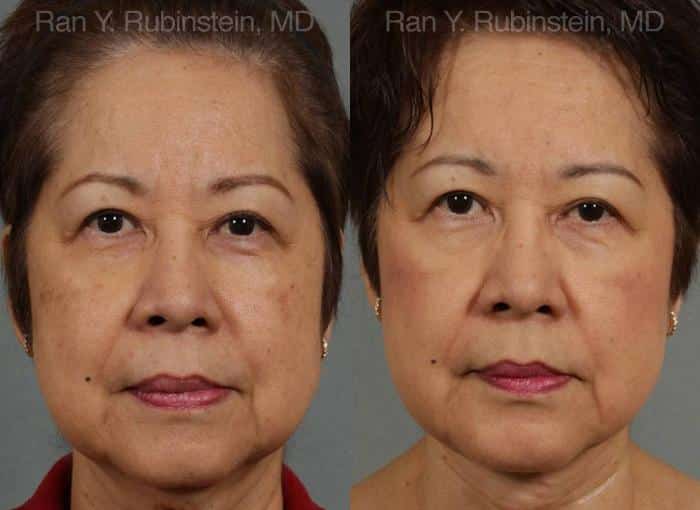 Face lift & Neck lift Before and After Photos in Newburgh, NY, Patient 12641