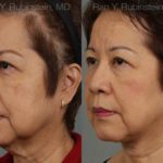 Face lift & Neck lift Before and After Photos in Newburgh, NY, Patient 12641