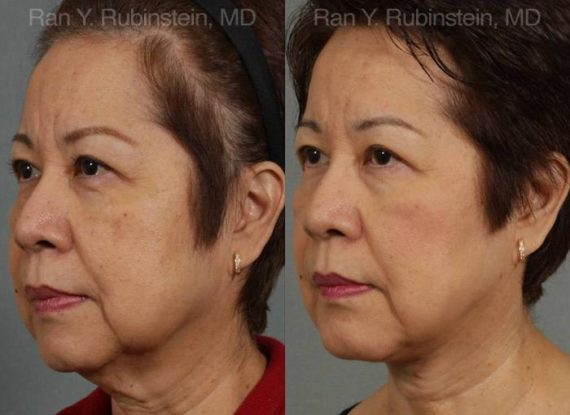 Face lift & Neck lift Before and After Photos in Newburgh, NY, Patient 12641