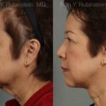 Face lift & Neck lift Before and After Photos in Newburgh, NY, Patient 12641