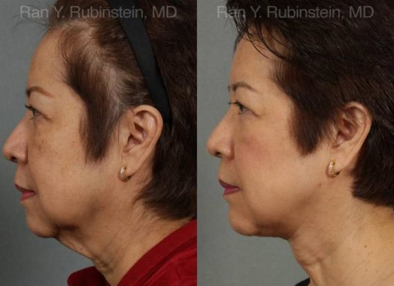 Face lift & Neck lift Before and After Photos in Newburgh, NY, Patient 12641