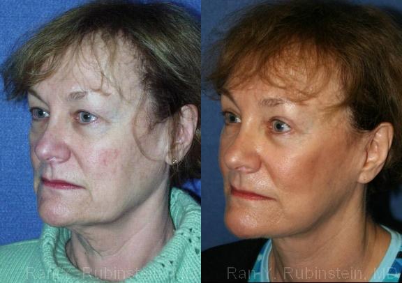 Face lift & Neck lift Before and After Photos in Newburgh, NY, Patient 12663