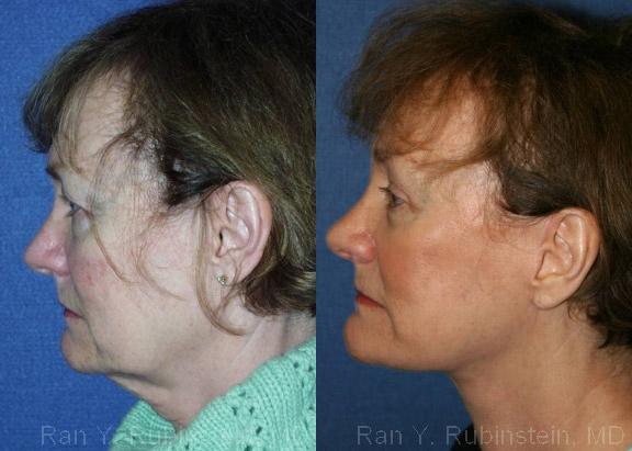 Face lift & Neck lift Before and After Photos in Newburgh, NY, Patient 12663