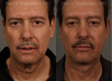 Face lift & Neck lift Before and After Photos in Montvale, NJ, Patient 12673