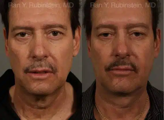 Face lift & Neck lift Before and After Photos in Newburgh, NY, Patient 12673