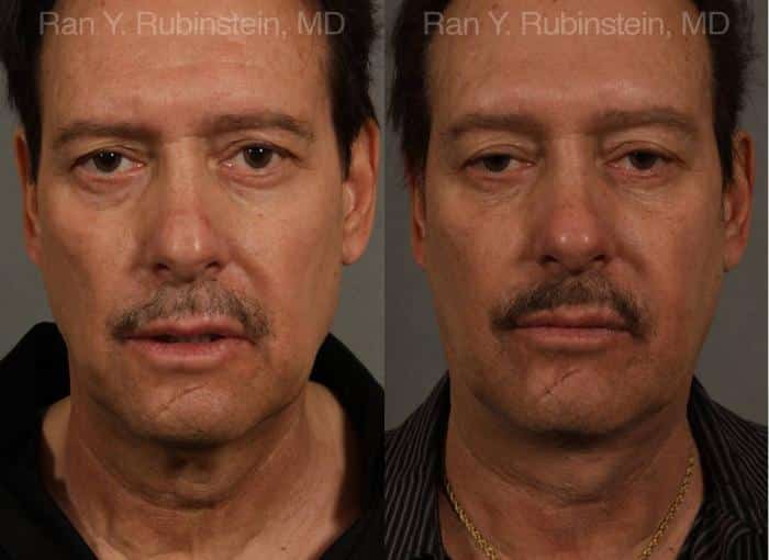 Face lift & Neck lift Before and After Photos in Newburgh, NY, Patient 12673