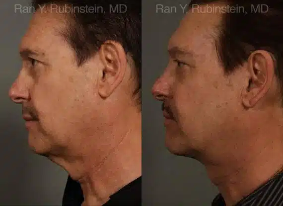 Face lift & Neck lift Before and After Photos in Newburgh, NY, Patient 12673