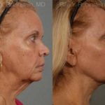 Face lift & Neck lift Before and After Photos in Newburgh, NY, Patient 12678