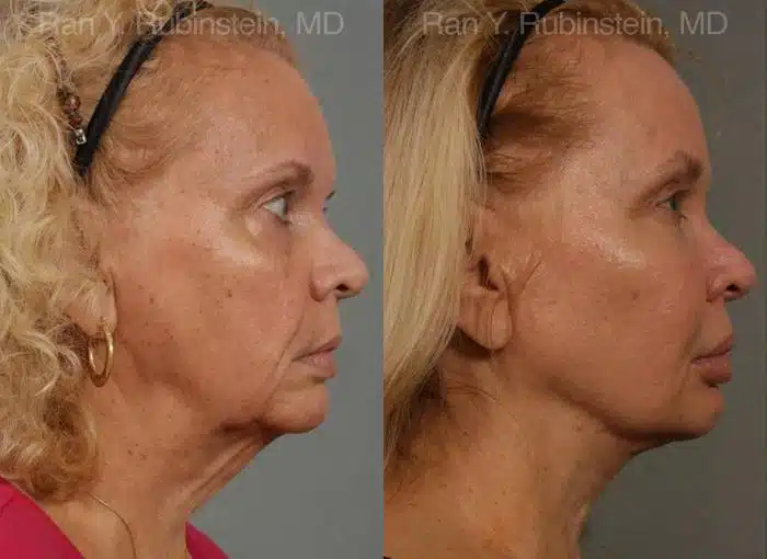 Face lift & Neck lift Before and After Photos in Newburgh, NY, Patient 12678