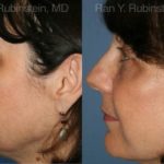 Fat Transfer Before and After Photos in Newburgh, NY, Patient 12689