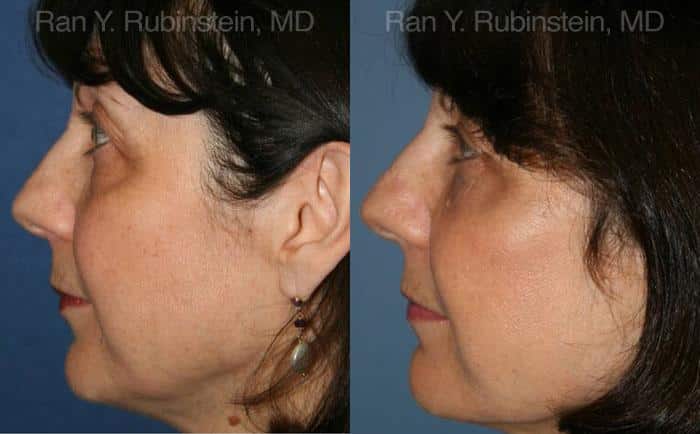 Fat Transfer Before and After Photos in Newburgh, NY, Patient 12689