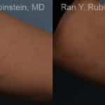 Laser Treatments Before and After Photos in Newburgh, NY, Patient 12807