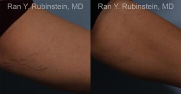 Laser Treatments Before and After Photos in Montvale, NJ, Patient 12807