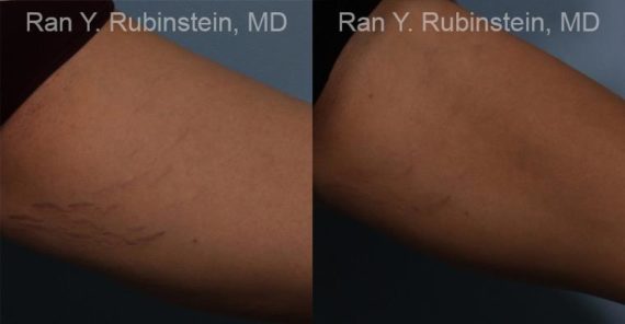 Laser Treatments Before and After Photos in Newburgh, NY, Patient 12807