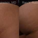 Laser Treatments Before and After Photos in Newburgh, NY, Patient 12812