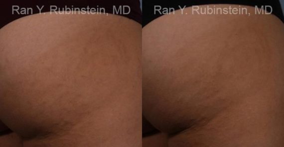 Laser Treatments Before and After Photos in Newburgh, NY, Patient 12812