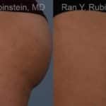 Laser Treatments Before and After Photos in Newburgh, NY, Patient 12812