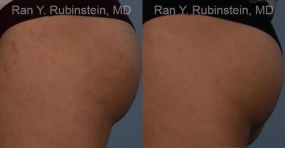 Laser Treatments Before and After Photos in Newburgh, NY, Patient 12812