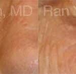 Laser Treatments Before and After Photos in Newburgh, NY, Patient 12836