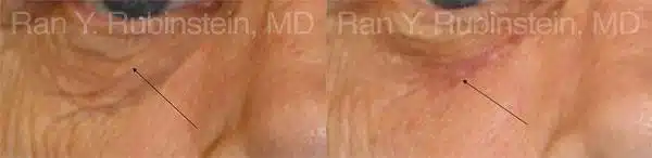 Laser Treatments Before and After Photos in Newburgh, NY, Patient 12836