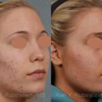 Laser Treatments Before and After Photos in Newburgh, NY, Patient 12842