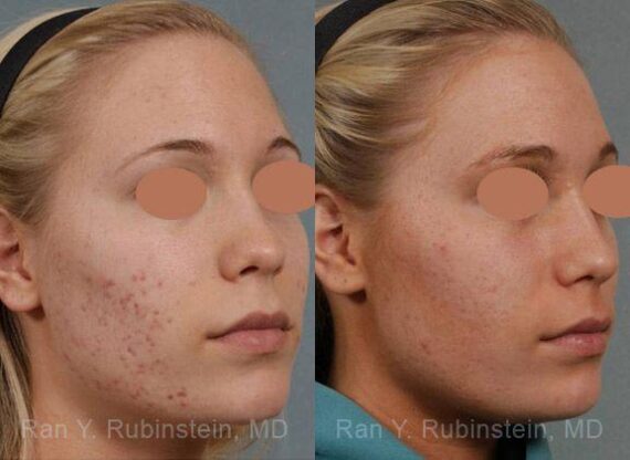 Laser Treatments Before and After Photos in Newburgh, NY, Patient 12842