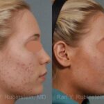 Laser Treatments Before and After Photos in Newburgh, NY, Patient 12842