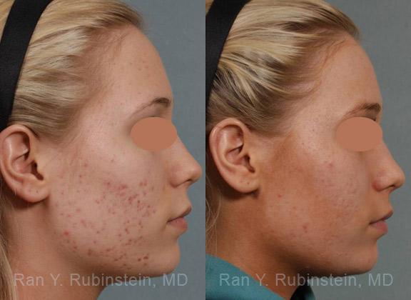 Laser Treatments Before and After Photos in Newburgh, NY, Patient 12842
