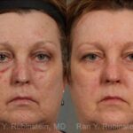 Laser Treatments Before and After Photos in Newburgh, NY, Patient 12850