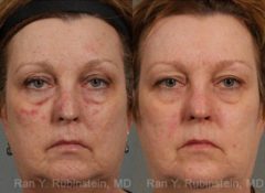 Laser Treatments Before and After Photos in Newburgh, NY, Patient 12850