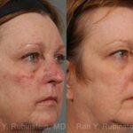 Laser Treatments Before and After Photos in Newburgh, NY, Patient 12850