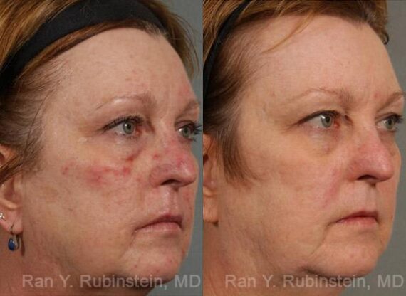 Laser Treatments Before and After Photos in Newburgh, NY, Patient 12850