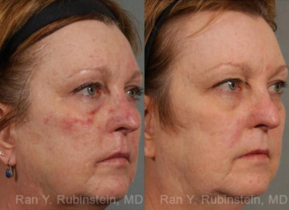 Laser Treatments Before and After Photos in Newburgh, NY, Patient 12850
