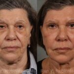 Laser Treatments Before and After Photos in Newburgh, NY, Patient 12855