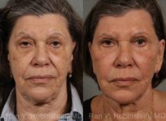 Laser Treatments Before and After Photos in Newburgh, NY, Patient 12855