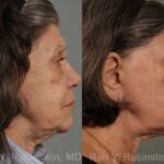 Laser Treatments Before and After Photos in Newburgh, NY, Patient 12855