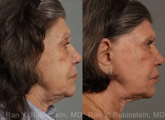 Laser Treatments Before and After Photos in Newburgh, NY, Patient 12855