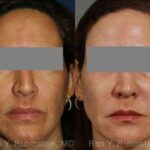 Laser Treatments Before and After Photos in Newburgh, NY, Patient 12865