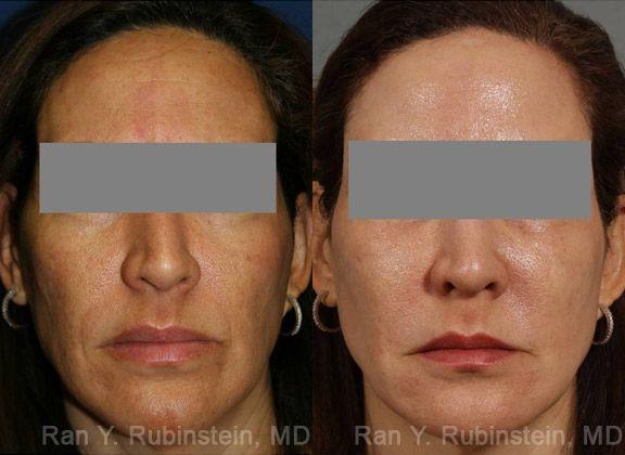 Laser Treatments Before and After Photos in Newburgh, NY, Patient 12865