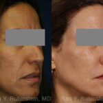 Laser Treatments Before and After Photos in Newburgh, NY, Patient 12865