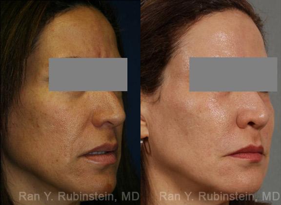 Laser Treatments Before and After Photos in Newburgh, NY, Patient 12865