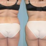 Liposuction Before and After Photos in Newburgh, NY, Patient 12870