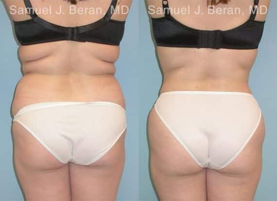 Liposuction Before and After Photos in Newburgh, NY, Patient 12870