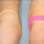 Liposuction Before and After Photos in Newburgh, NY, Patient 12873