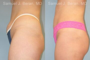 Liposuction Before and After Photos in Montvale, NJ, Patient 12873