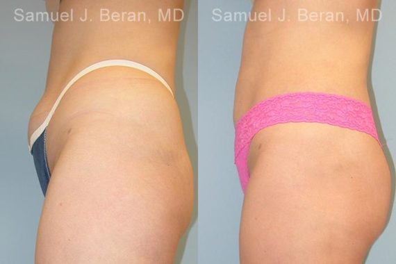 Liposuction Before and After Photos in Newburgh, NY, Patient 12873