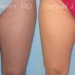 Liposuction Before and After Photos in Newburgh, NY, Patient 12876