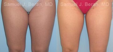 Liposuction Before and After Photos in Montvale, NJ, Patient 12876